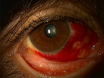 充血 病気 の 目 目の充血と一緒に目やにが出る時の原因・病気は？
