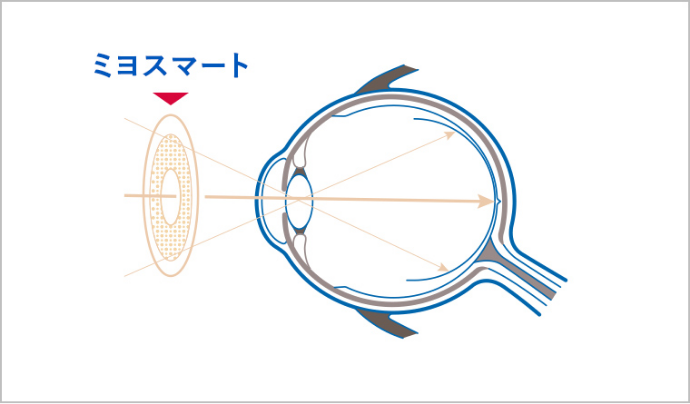矯正なしの近視