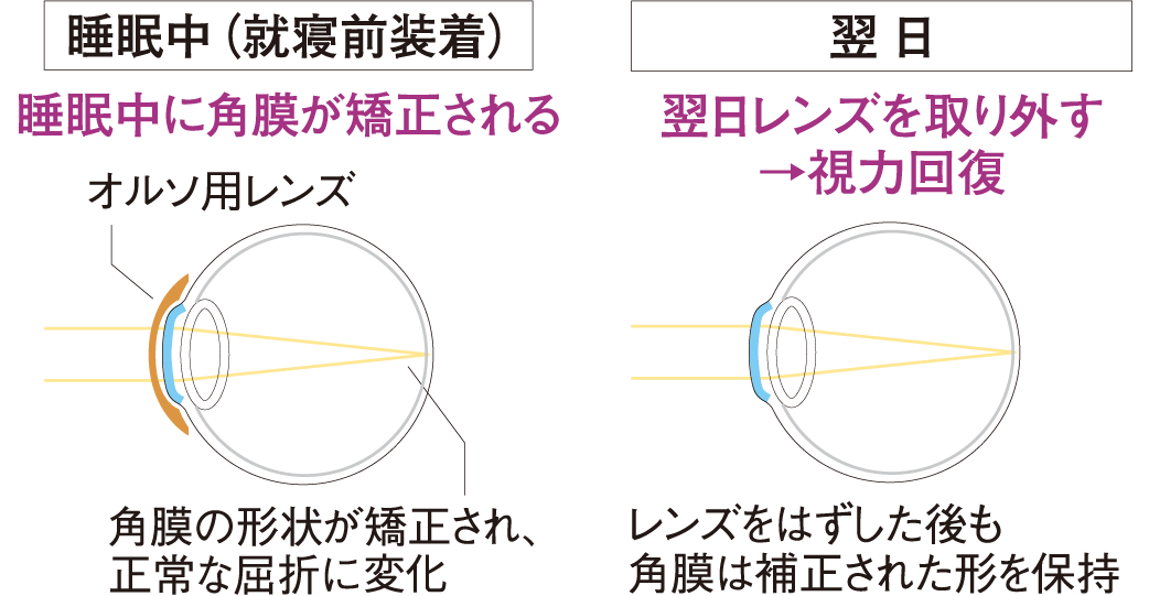 2.オルソケラトロジーの仕組み