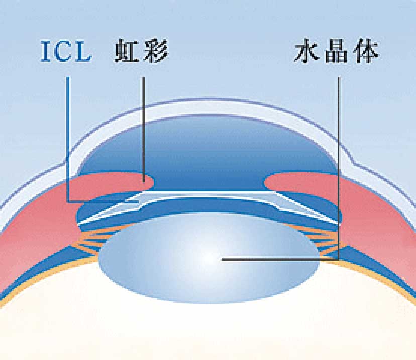 有水晶体眼内レンズ（ICL）